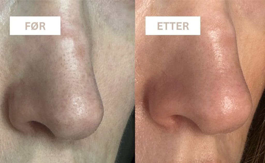 før og ettter BEHANDLING