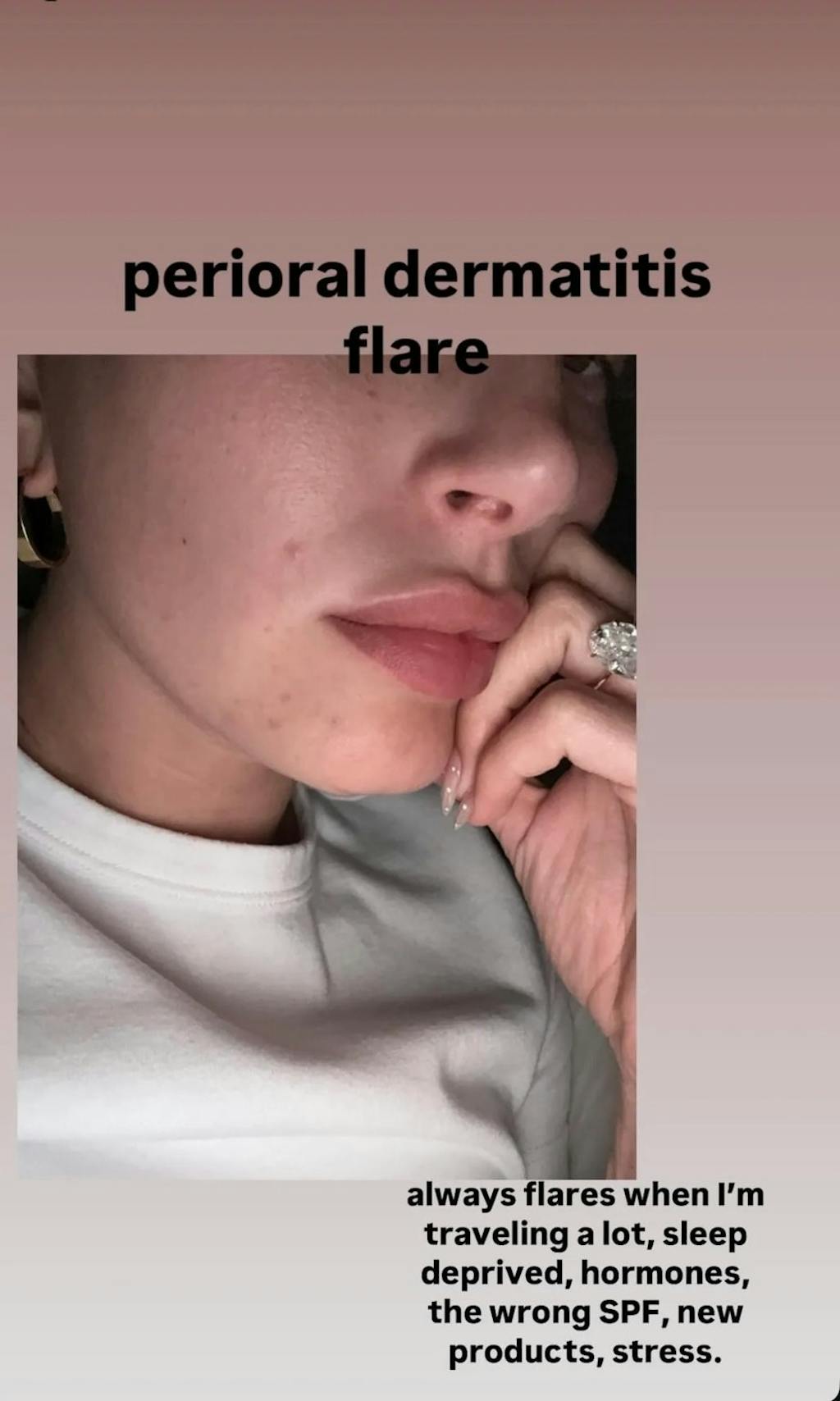 Haily Bieber Perioal dermatitt