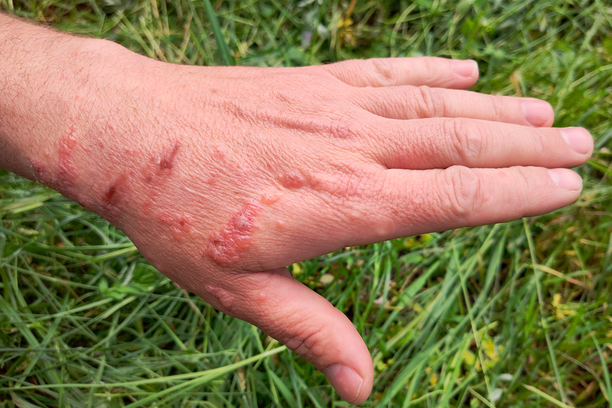 Udslæt fra vil pastinak