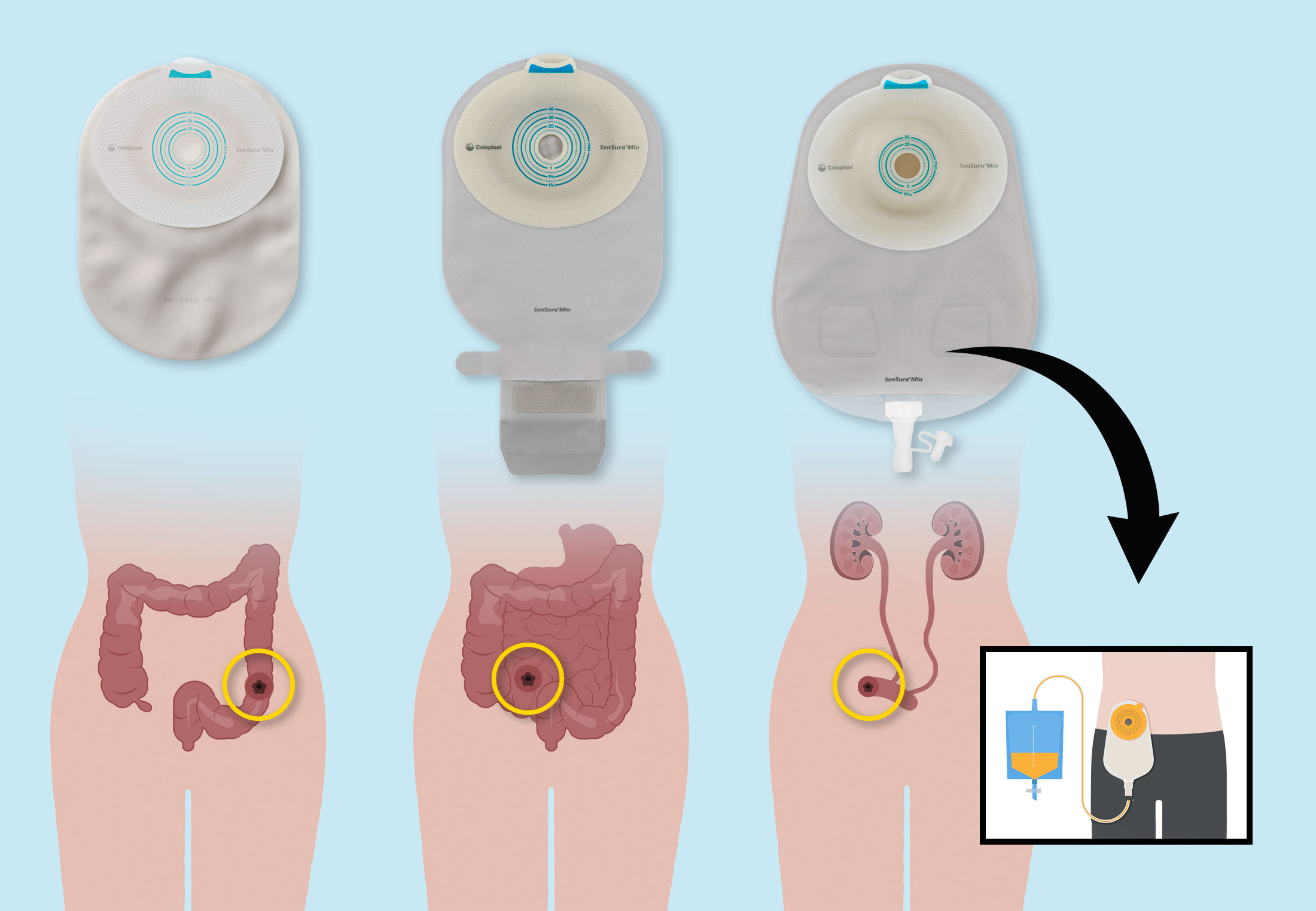 stomip-sen-gav-patienterna-livsgl-djen-tillbaka-varldenshistoria-se