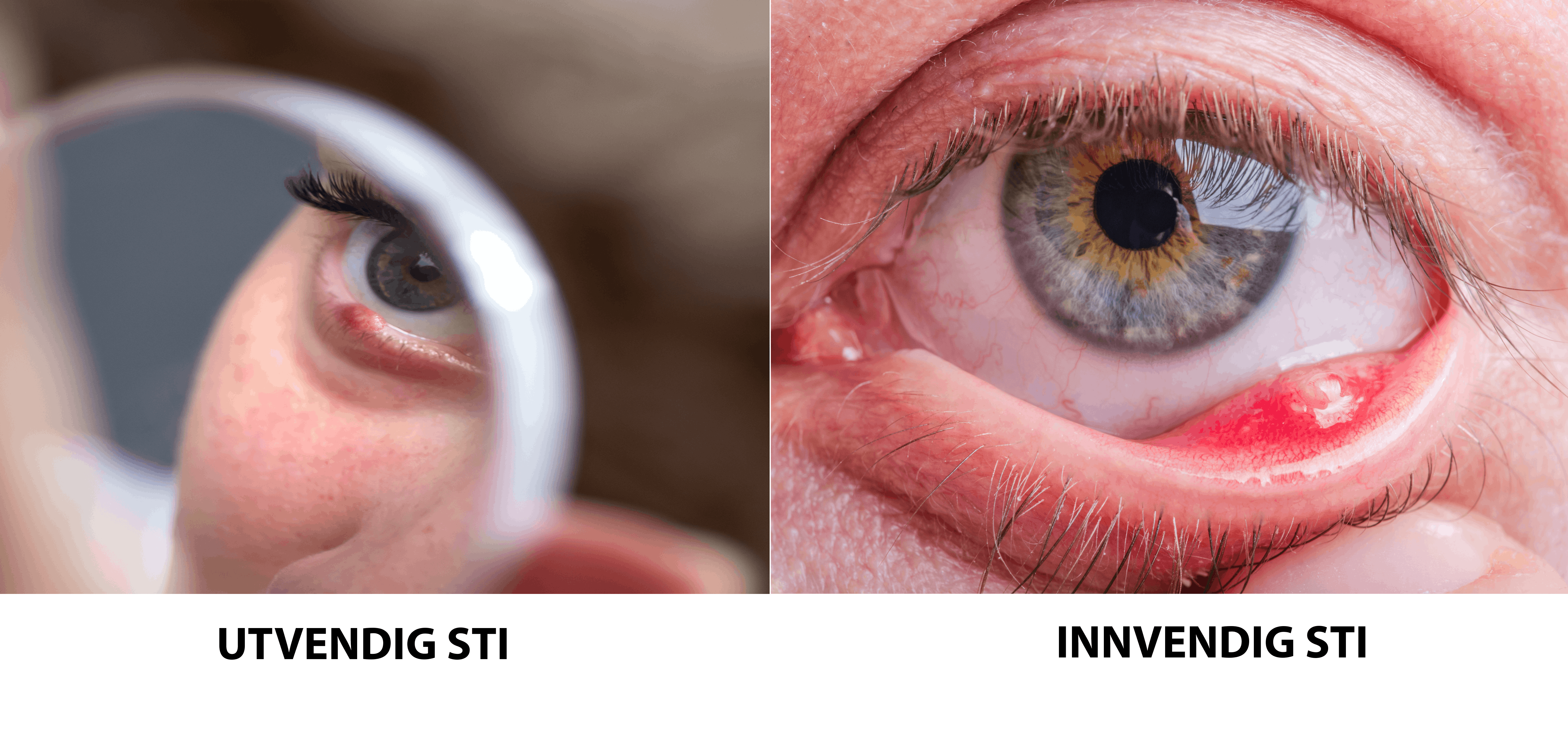 To typer sti på øyet