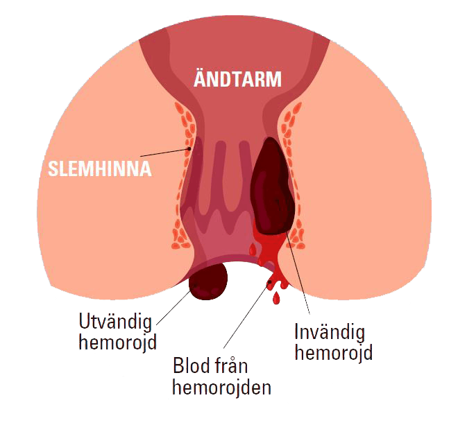 Typer av hemorrojder