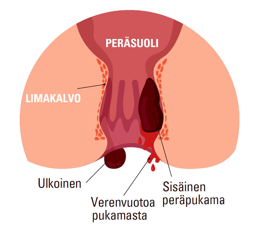 Eri peräpukamatyyppejä