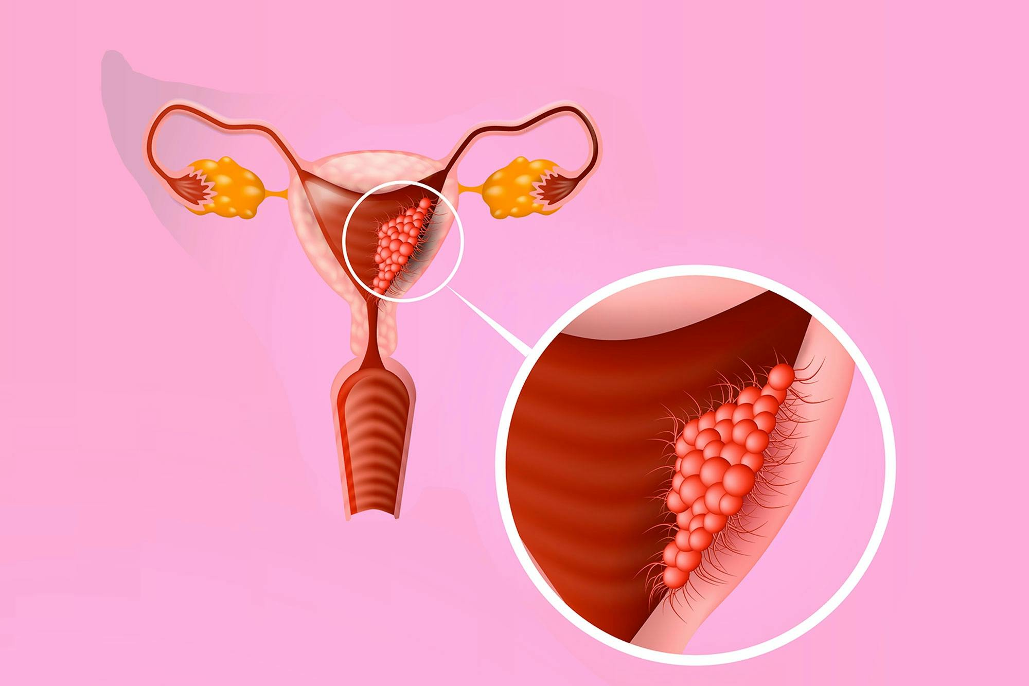 Kohdunrungon syöpä
