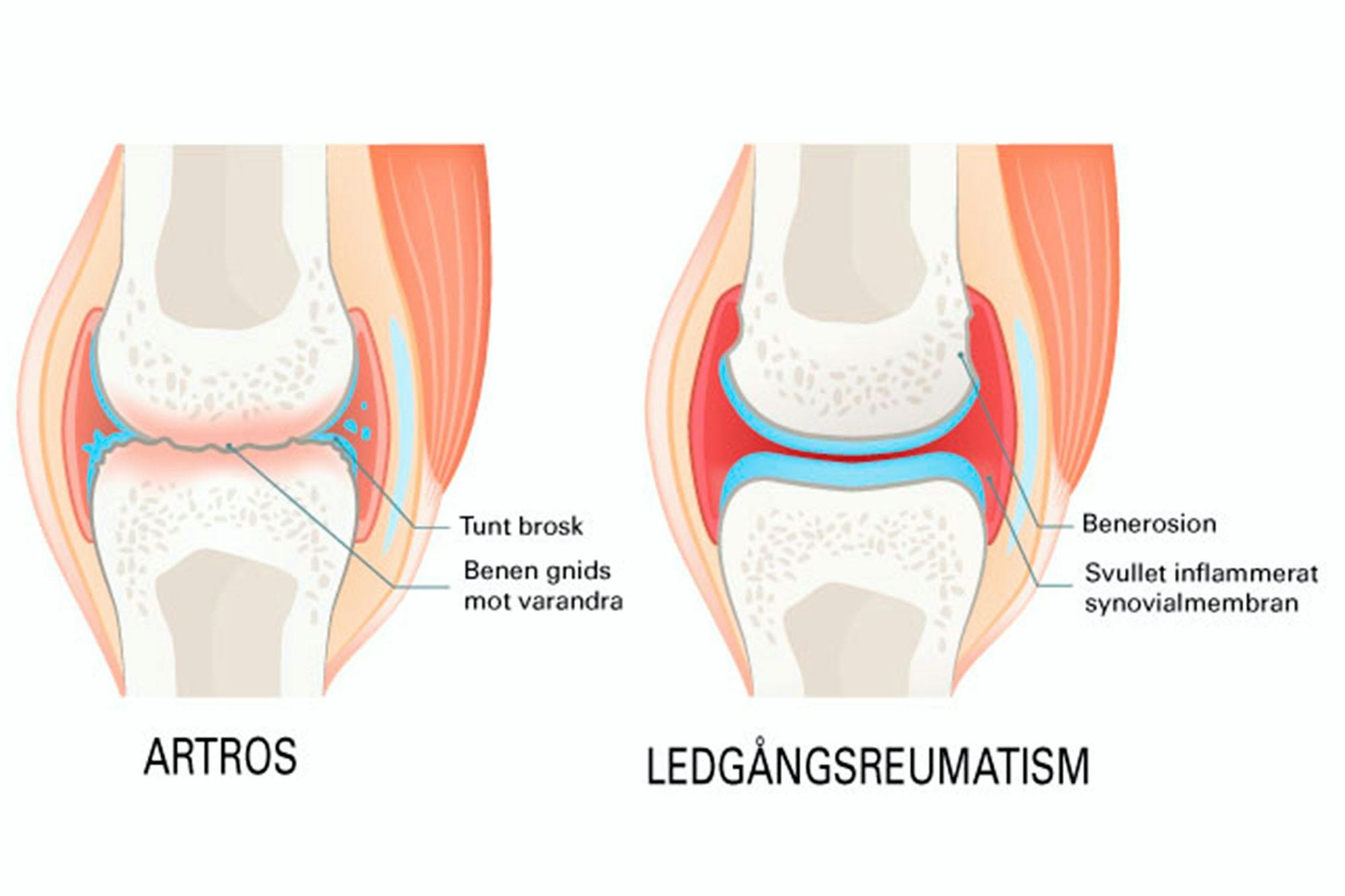 Artros och ledgångsreumatism