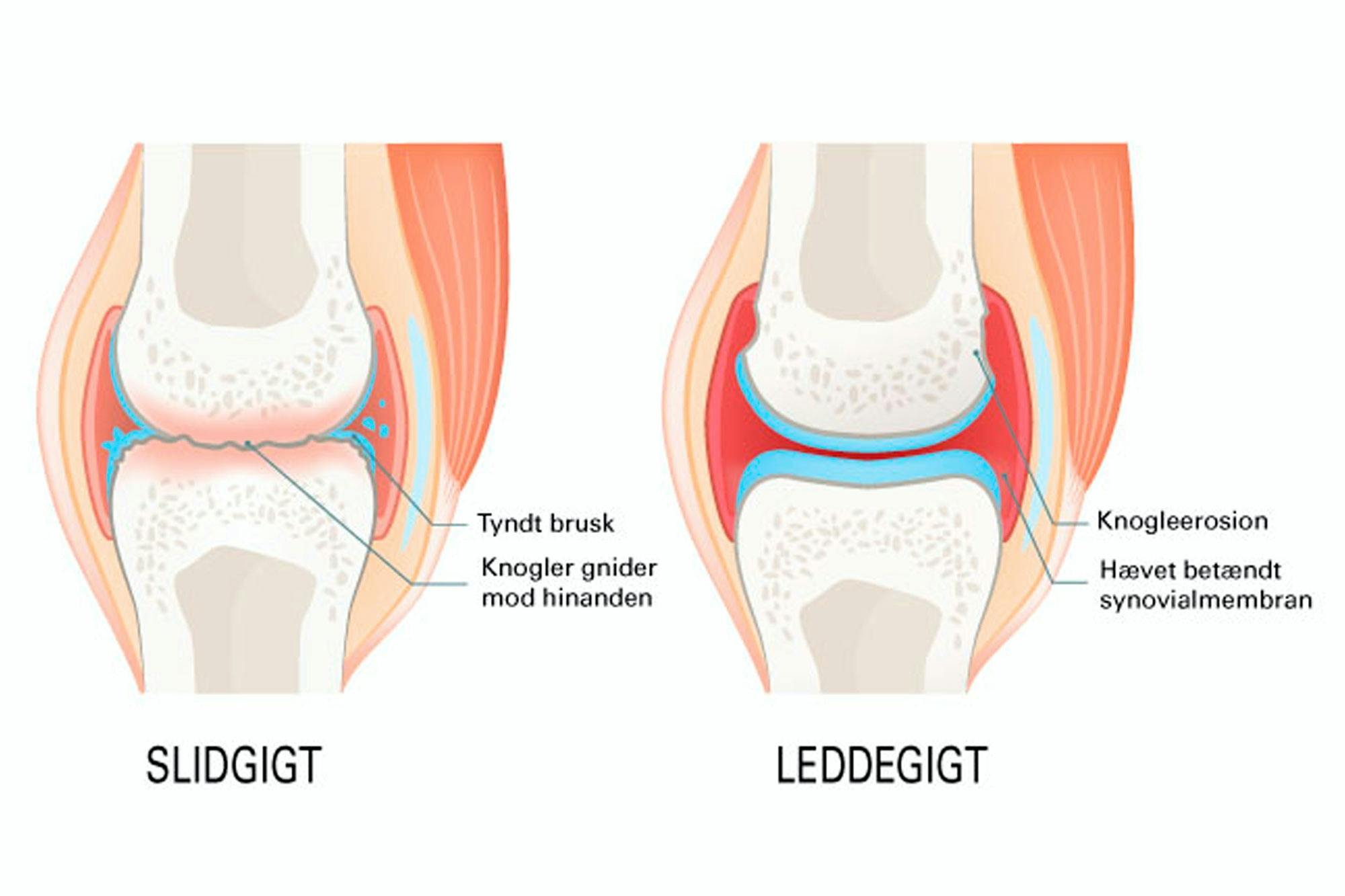 Slidgigt og leddegigt