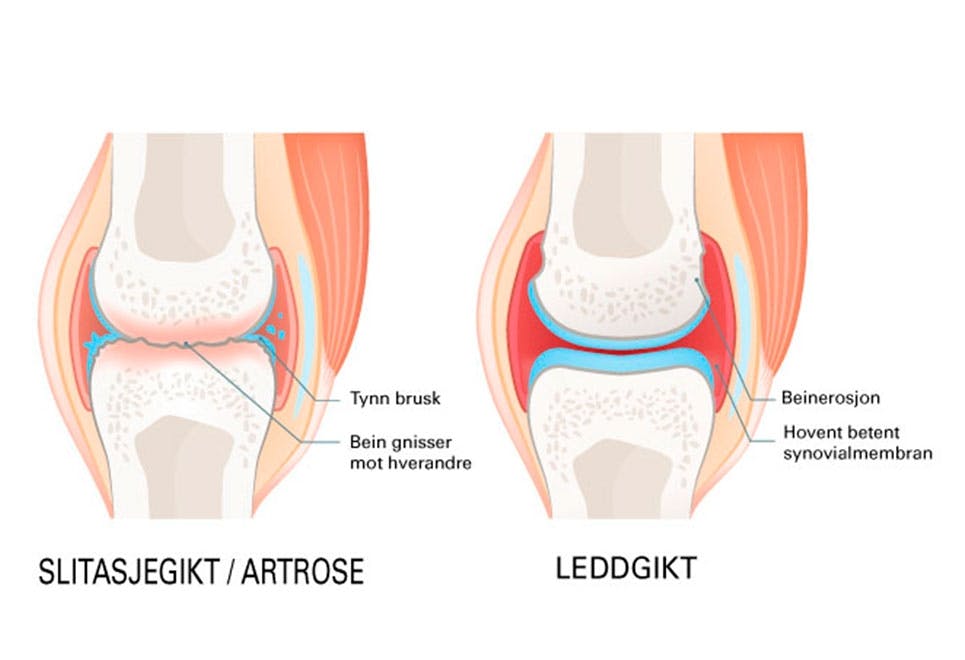 Slitasjegikt og leddgikt