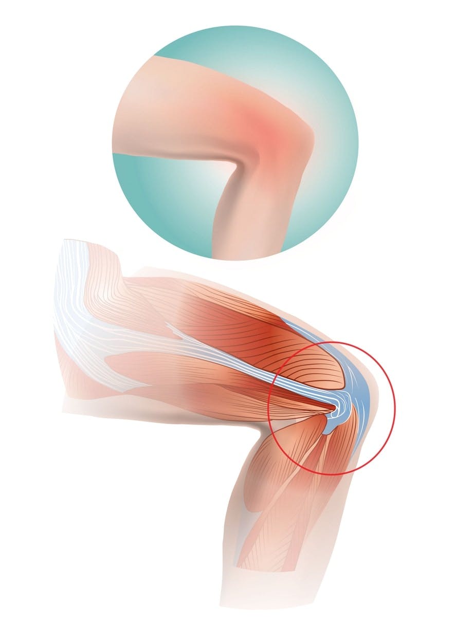 Forklaring på løperkne
