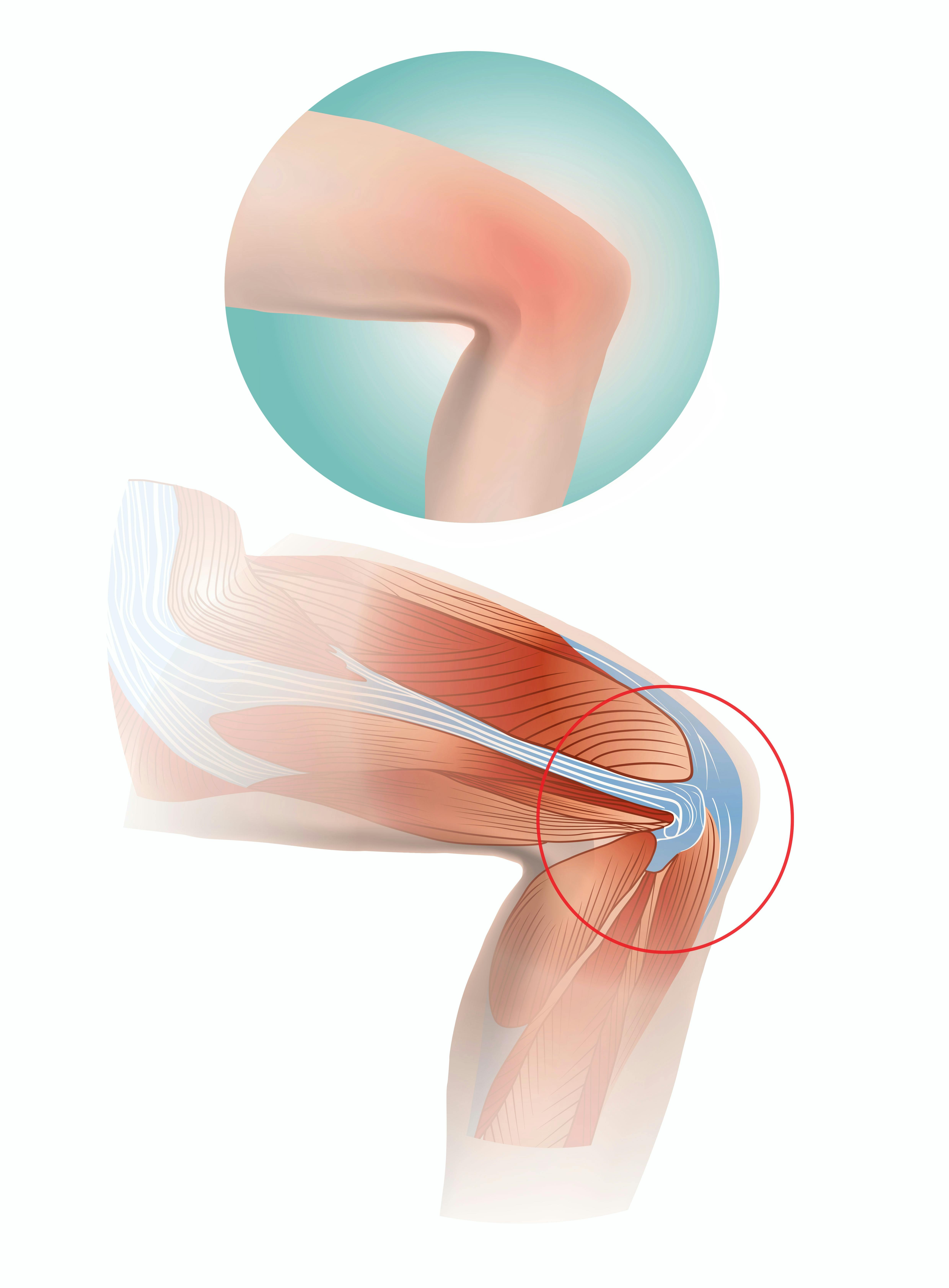 Forklaring på løberknæ