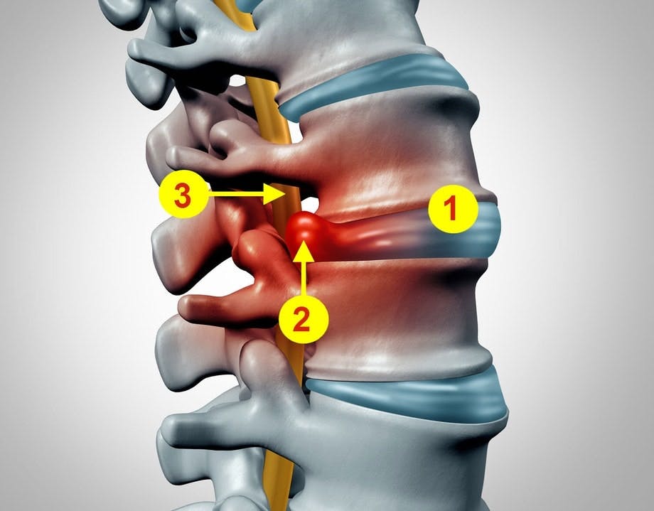 Skiveprolaps i ryggraden