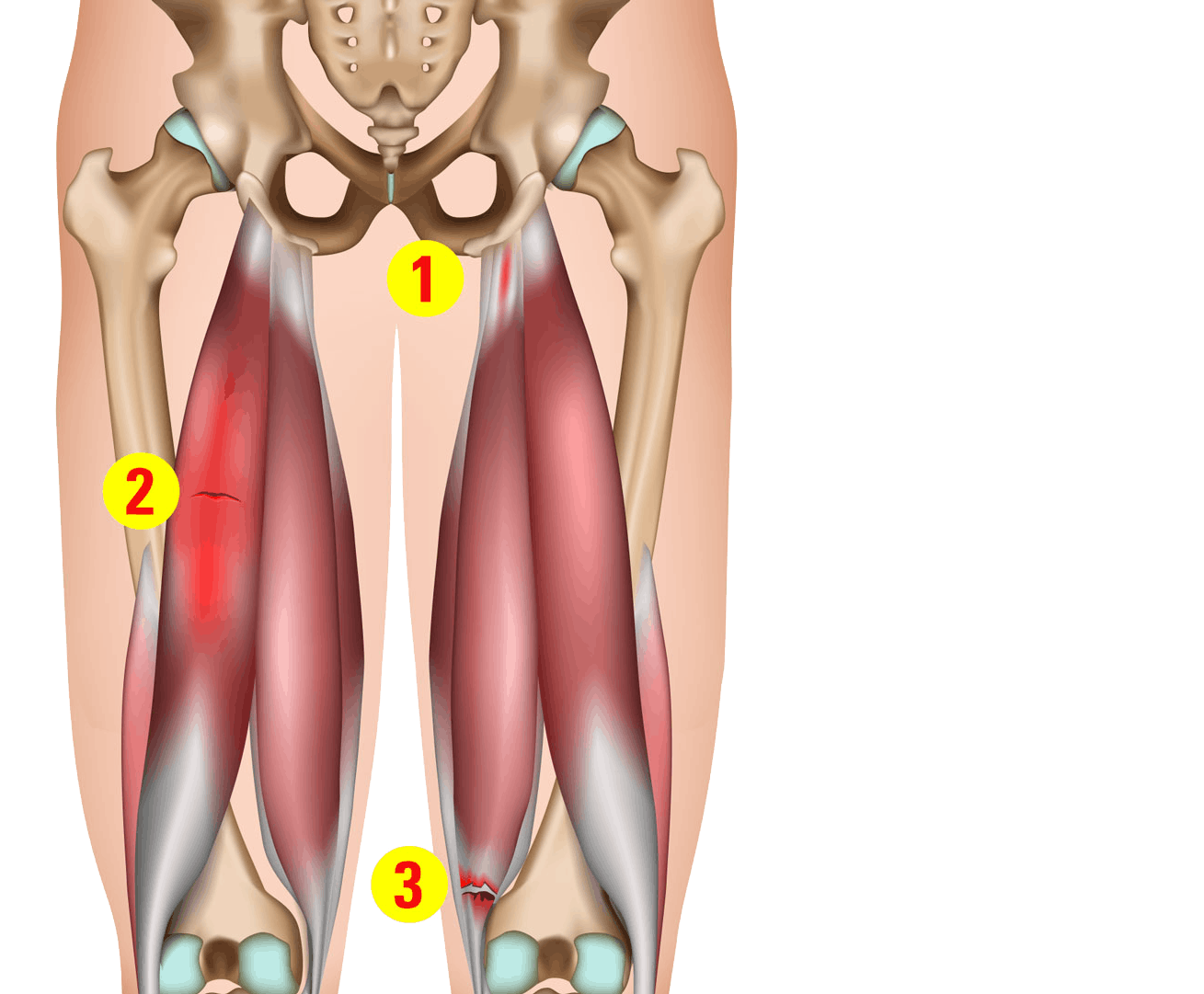 Forskellige grader af fibersprængninger