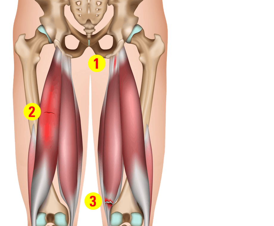 Eriasteisia lihasrevähdyksiä
