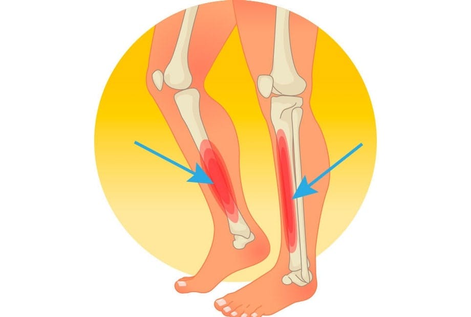 Benhinneinflammation