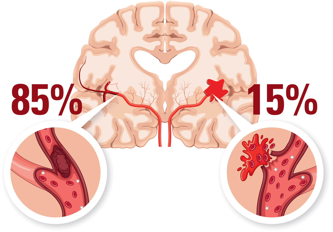 Stroke beror på en blodpropp i hjärnan eller hjärnblödning