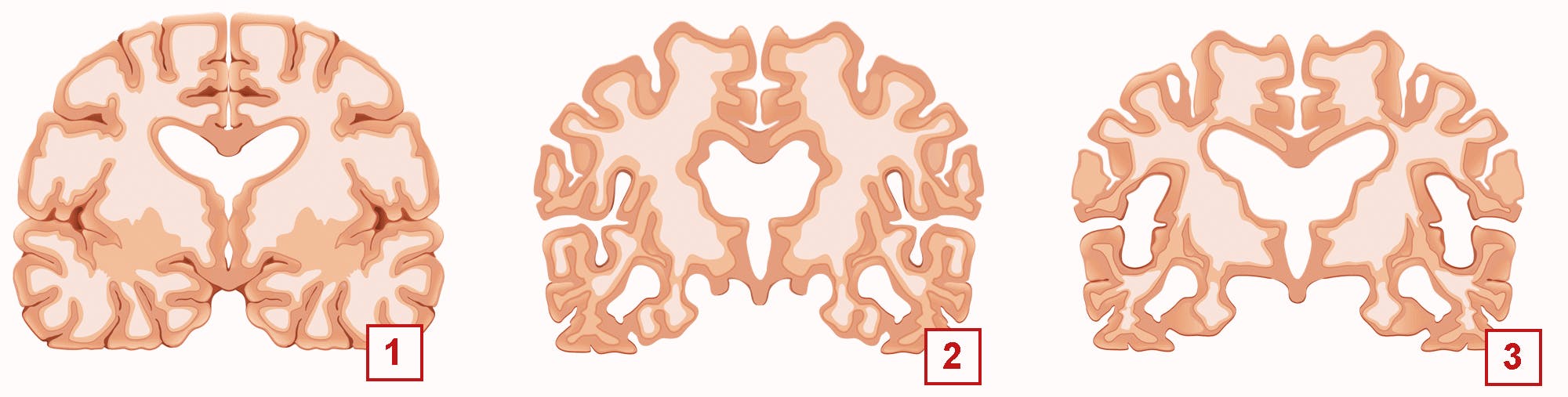 Hjernen skrumper når vi rammes av Alzheimers