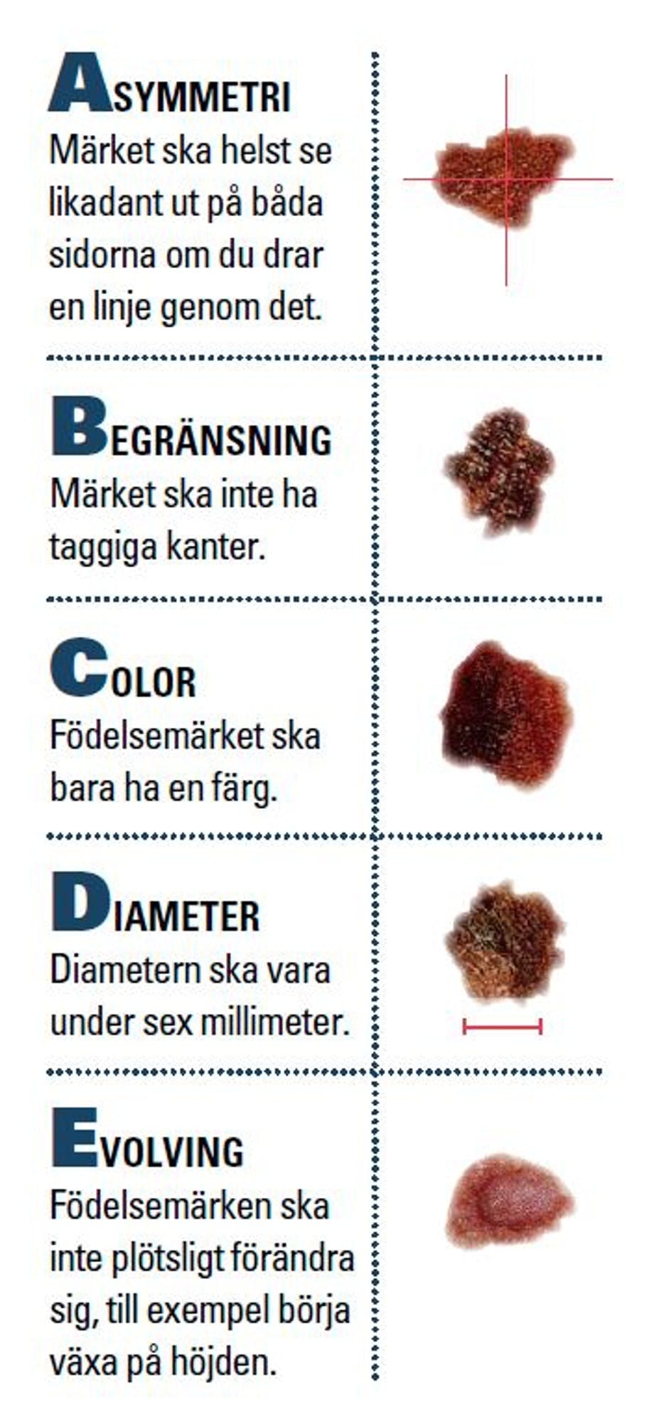 Hur ser malignt melanom ut? Bilder av malignt melanom