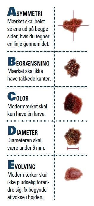 Hvordan ser modermærkekræft ud? Billeder af modermærkekræft