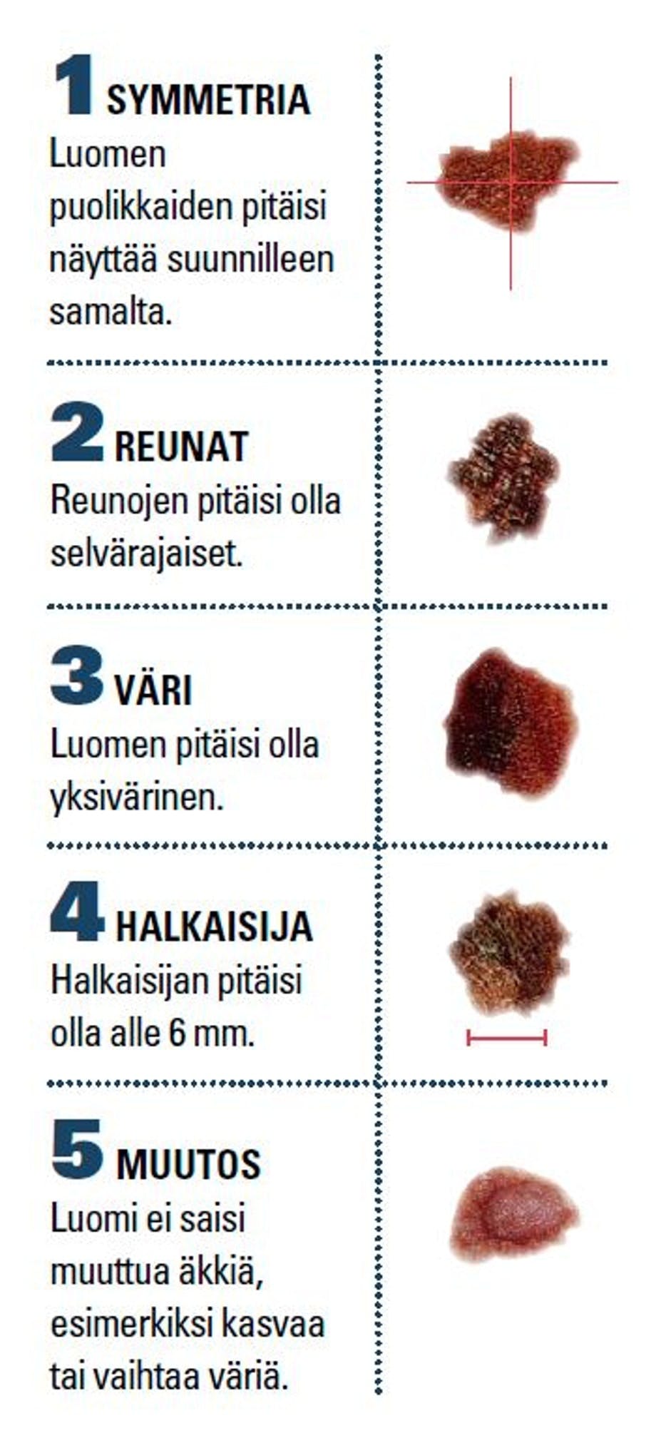Mistä melanooman tunnistaa? Kuvia melanoomasta.