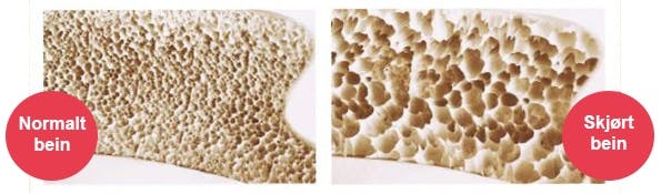 Normalt bein og bein som er rammet av beinskjørhet
