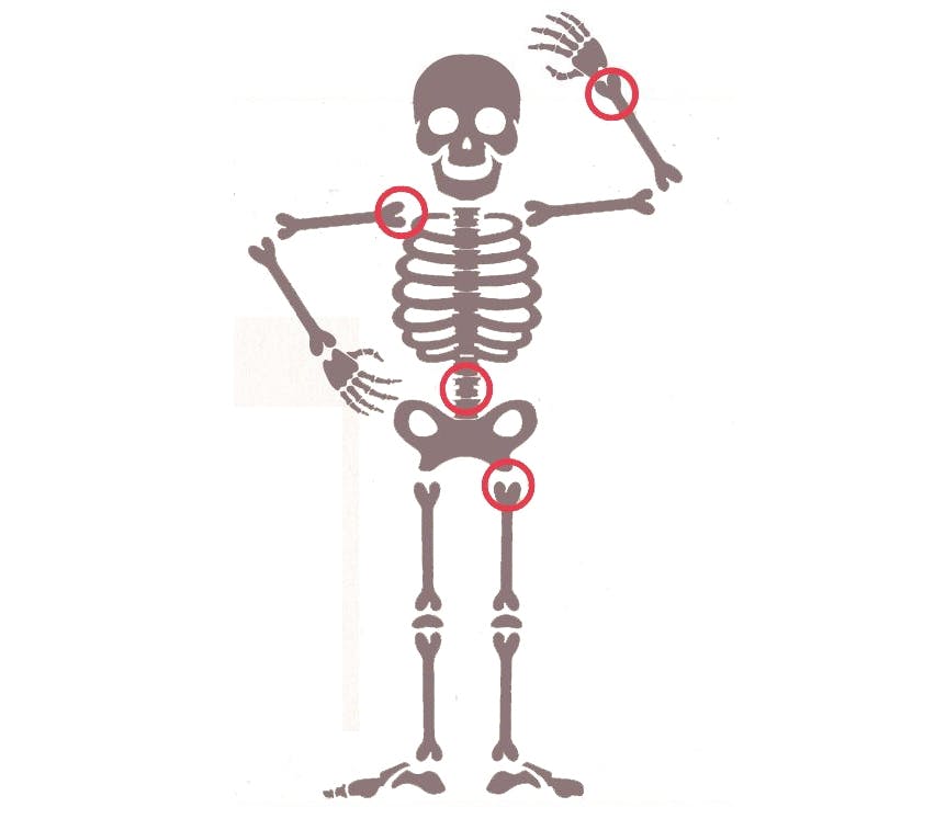 Disse knogler brækker især, når du har osteoporose / knogleskørhed