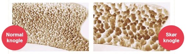 Normal knogle og knogle, der er ramt af knogleskørhed/osteoporose