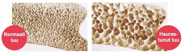Normaali ja osteoporoosin haurastuttama luu