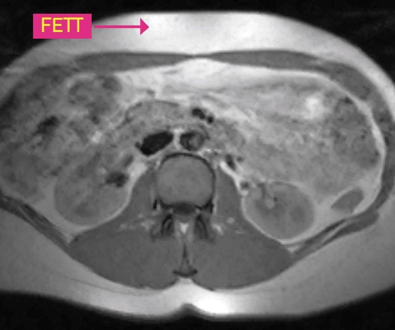 Magefett rett under huden