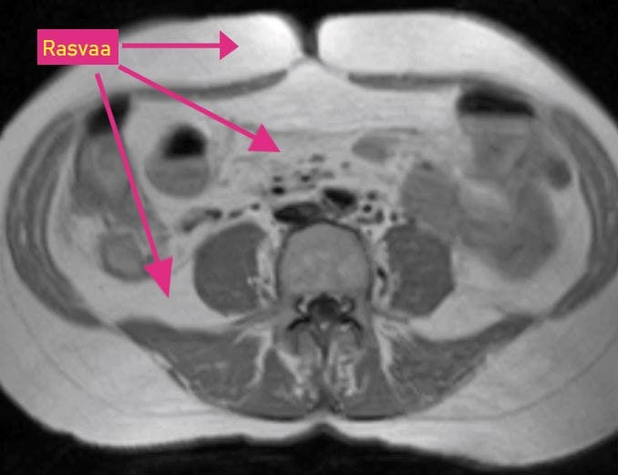Rasvaa sisäelinten välissä