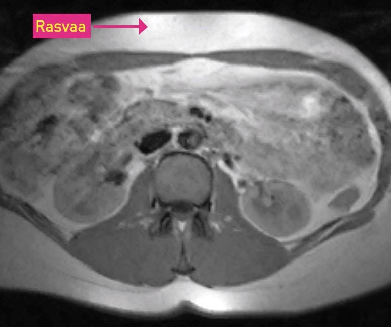 Rasvaa välittömästi ihon alla