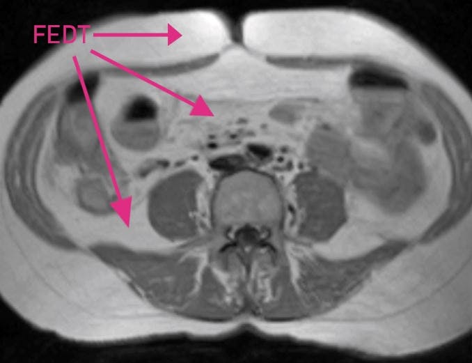 Mavefedt mellem indvoldene 