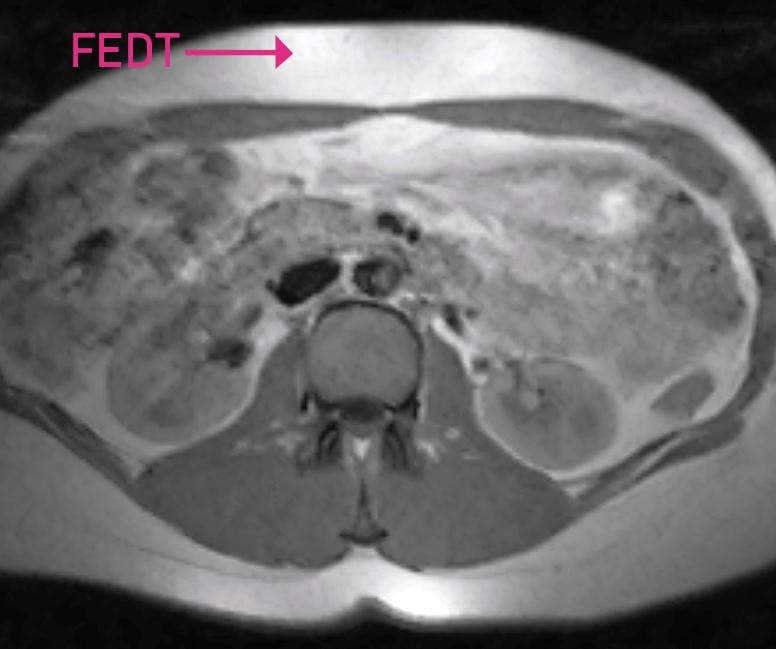 Mavefedt lige under huden