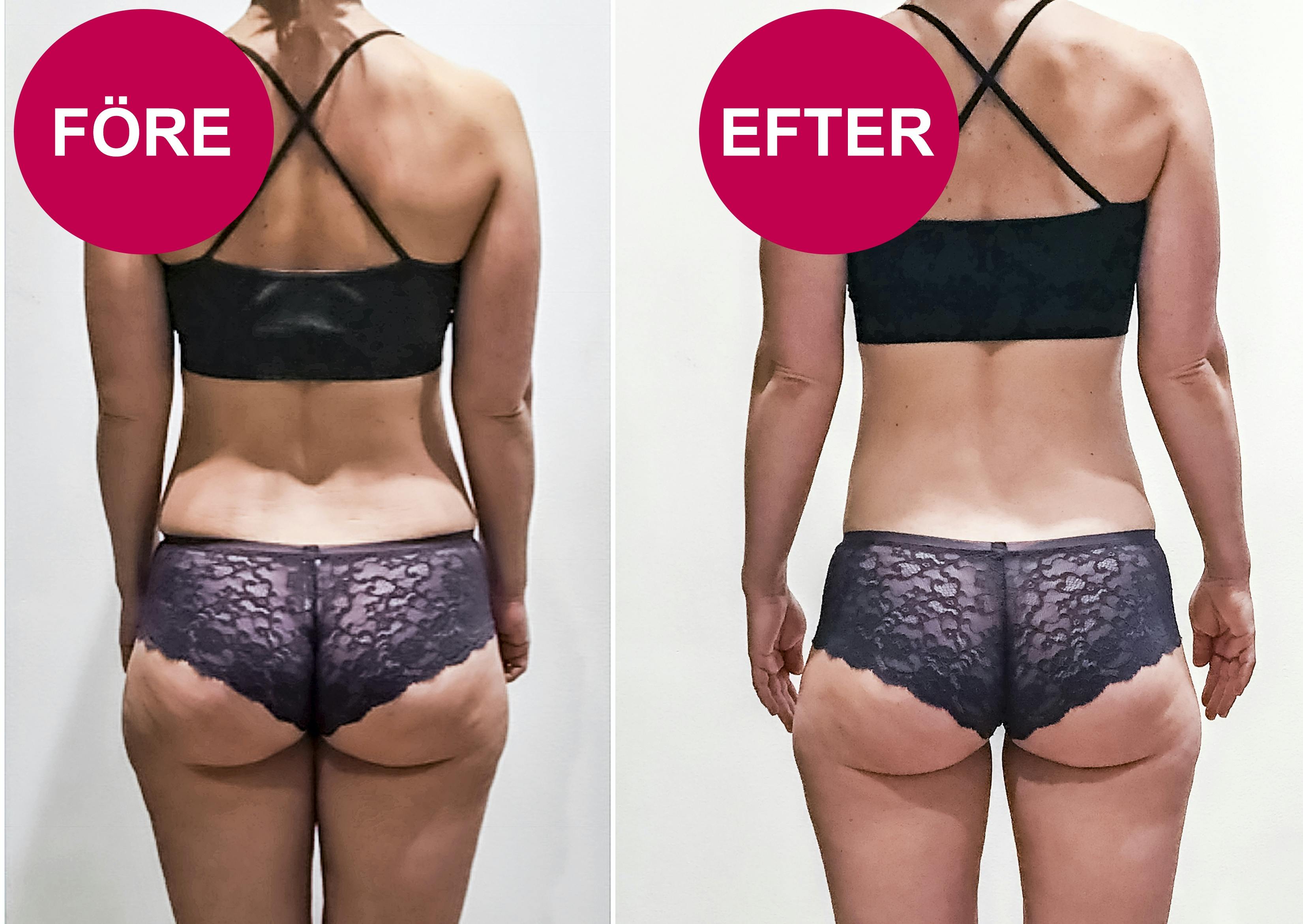 Före- och efterbilder på lår