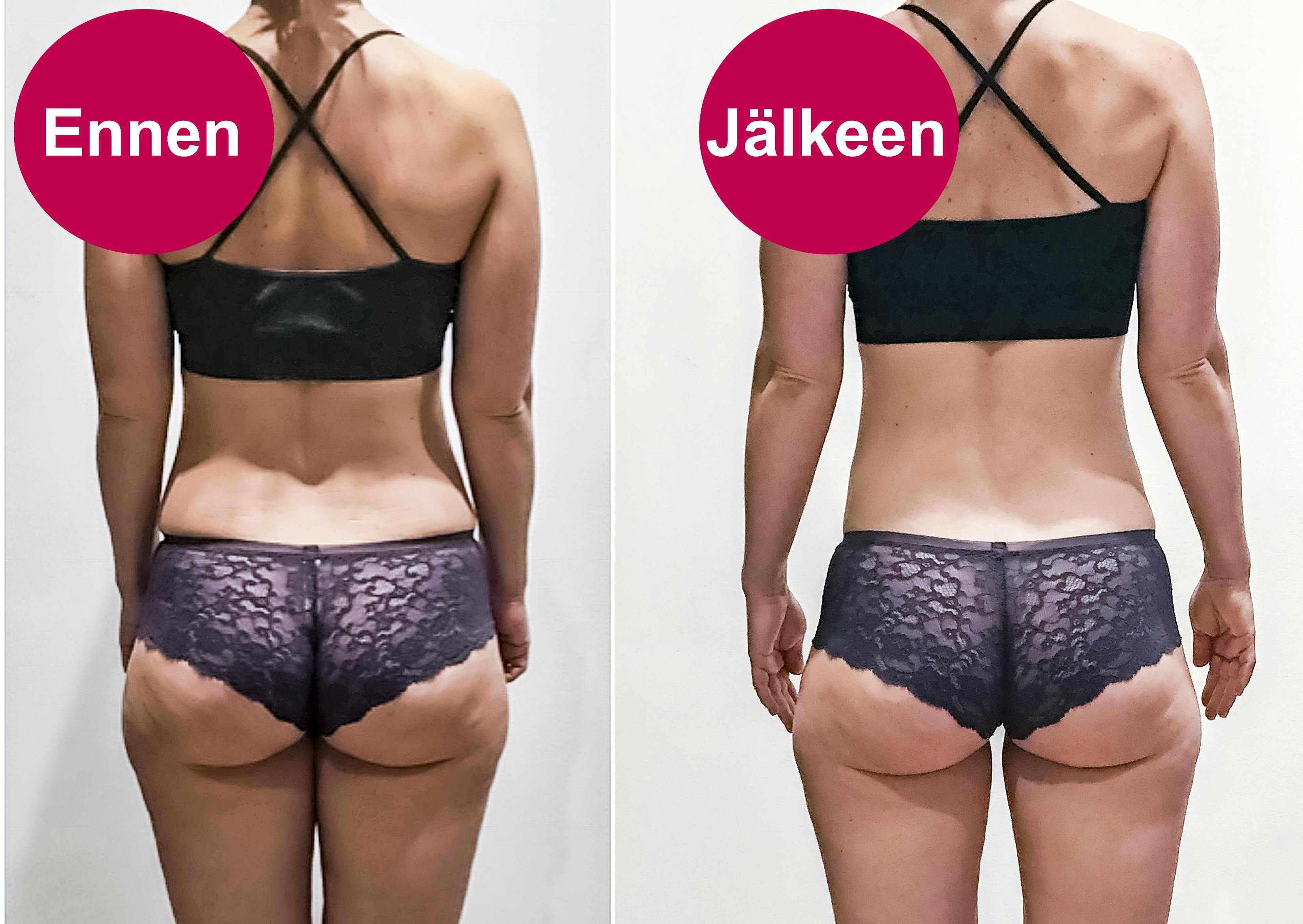 Ennen- ja jälkeen -kuvat pakaroista