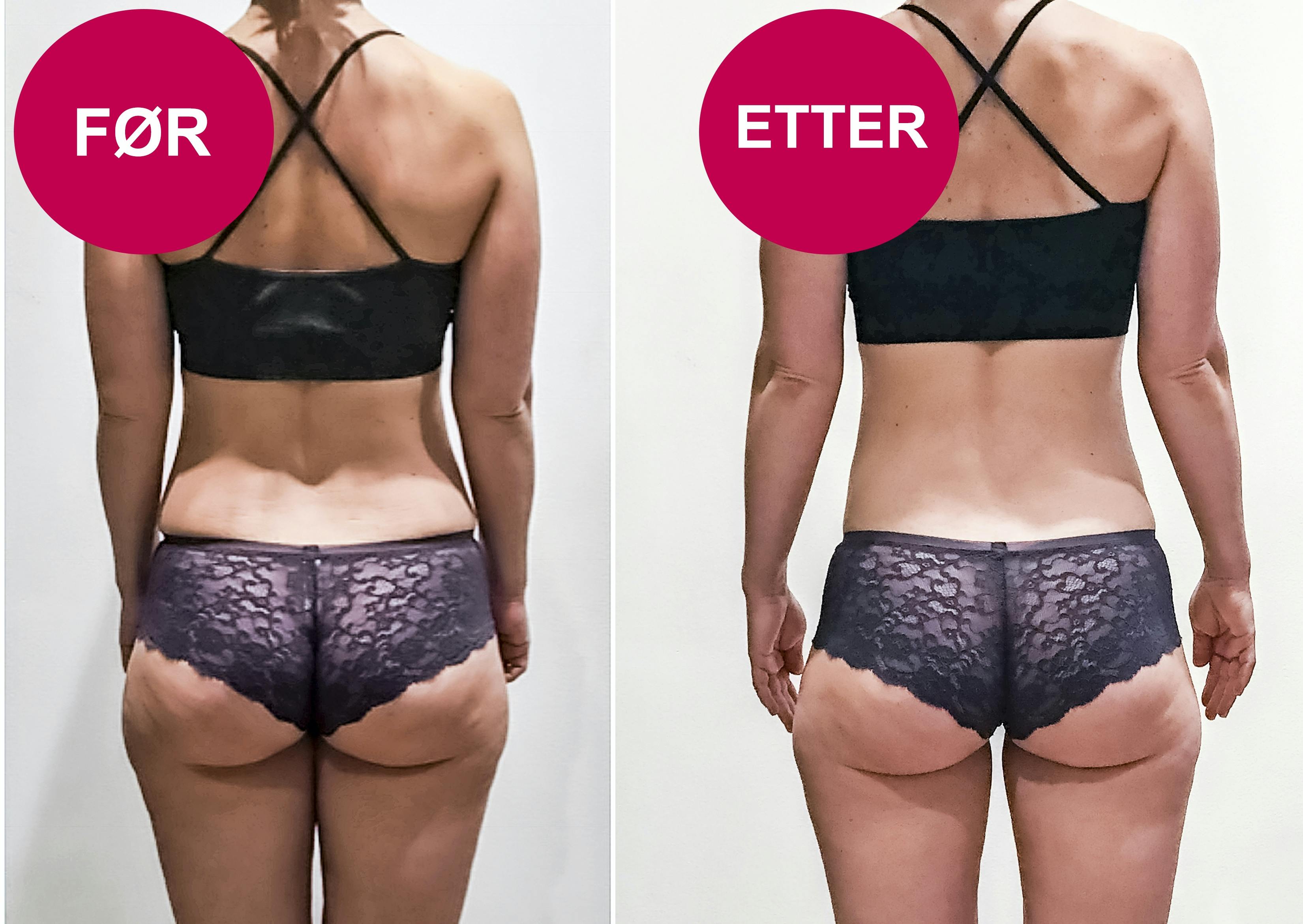 Før- og etter-bilder av baken