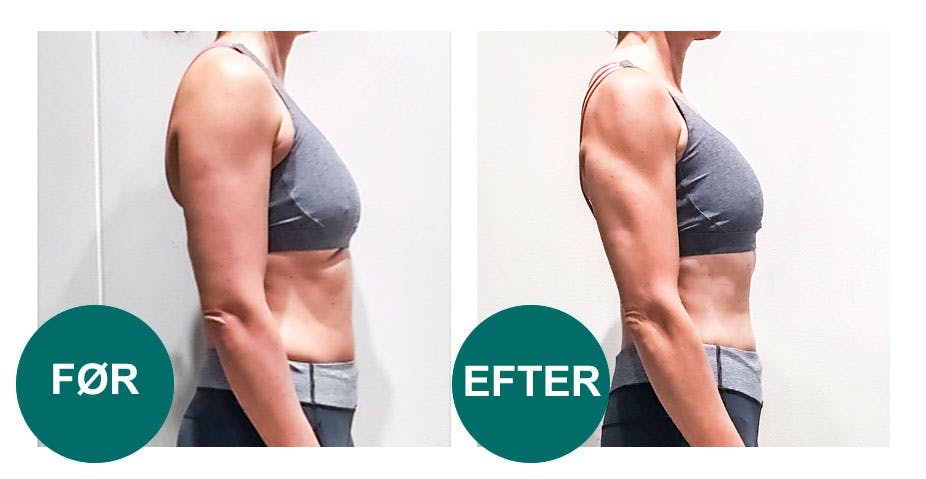 Før og efter-billeder af arme