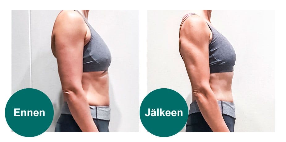 Ennen- ja jälkeenkuvat käsivarsista