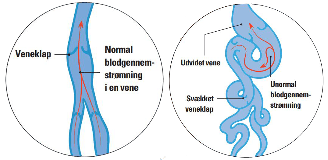 Venklaffar – iillustration som visar vener med och utan åderbråck