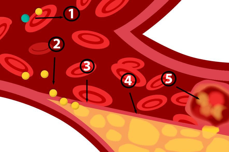Kolesterol täpper till blodkärlet