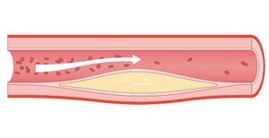 Blodåre med åreforkalkning