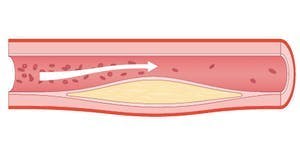 Blodådra med åderförkalkning