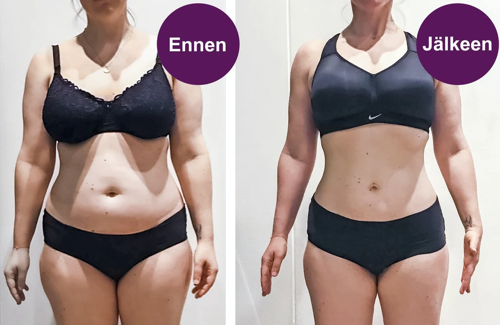 Ennen- ja jälkeen-kuvat vatsasta