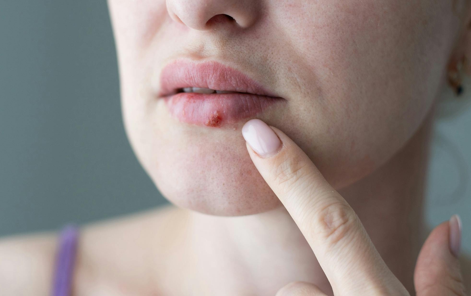 Munsår vid förkylning