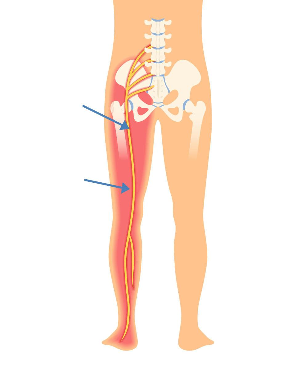 Her kan du se iskias-nerven og hvor smerterne sidder.