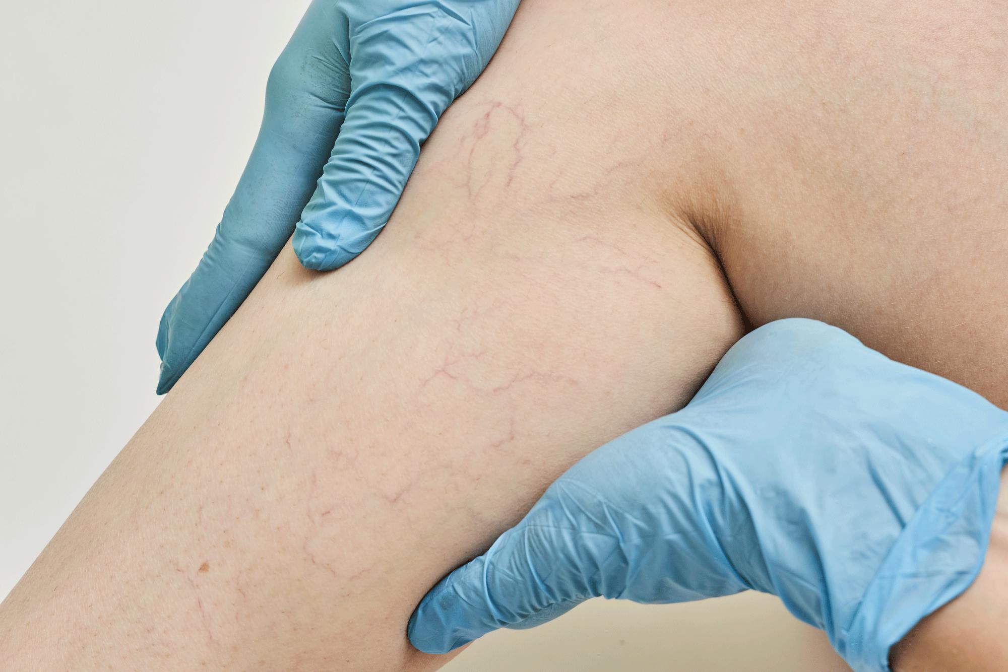 Åreknuder på benet