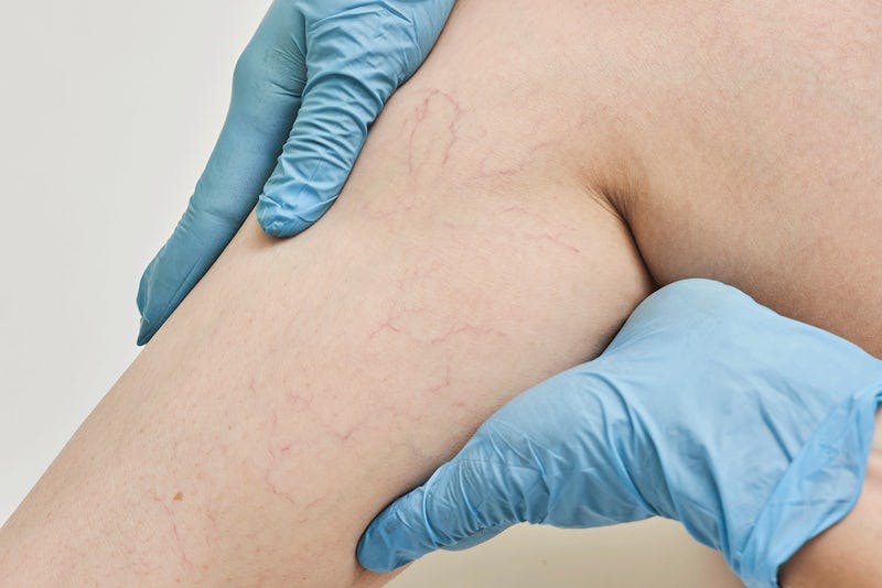 Åreknuter på beinet