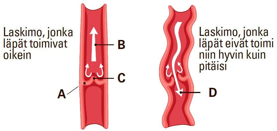Verisuonten läppiä