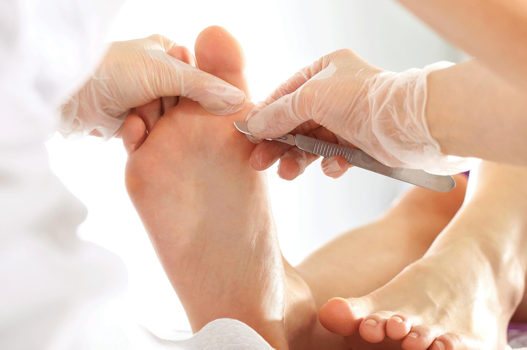 Fotterapeut tar bort liktorn