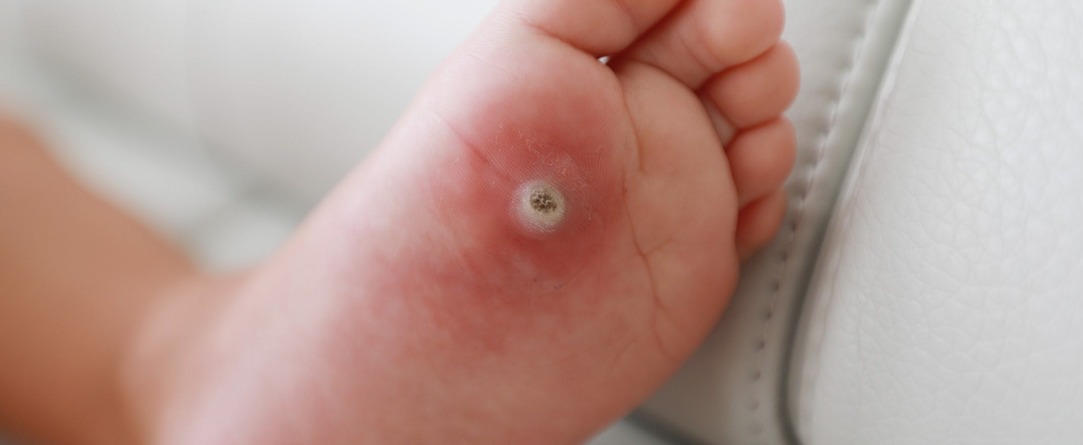 Miltä jalkapohjan syylä näyttää?