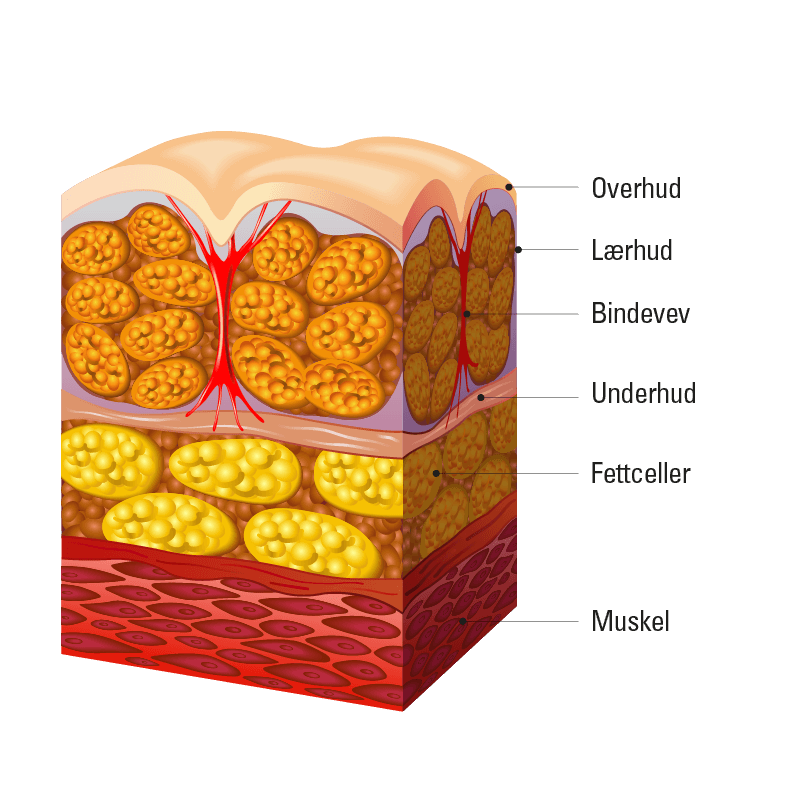 Forebygging av appelsinhud