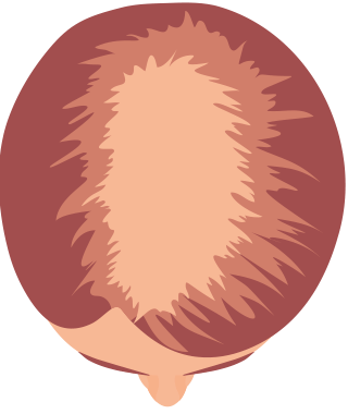 Hårtab - mønsterskaldethed